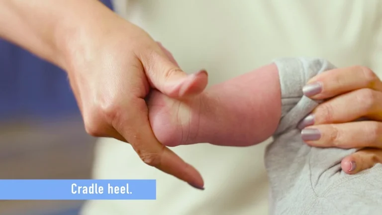 Clubfoot – Causes, Treatment, and Physiotherapy in Multan